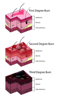 First Aid for Burns